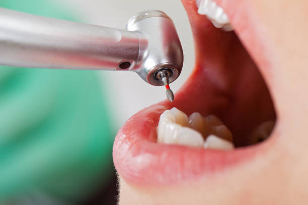 Best Broken or Chipped Tooth Repair in Hearne, TX